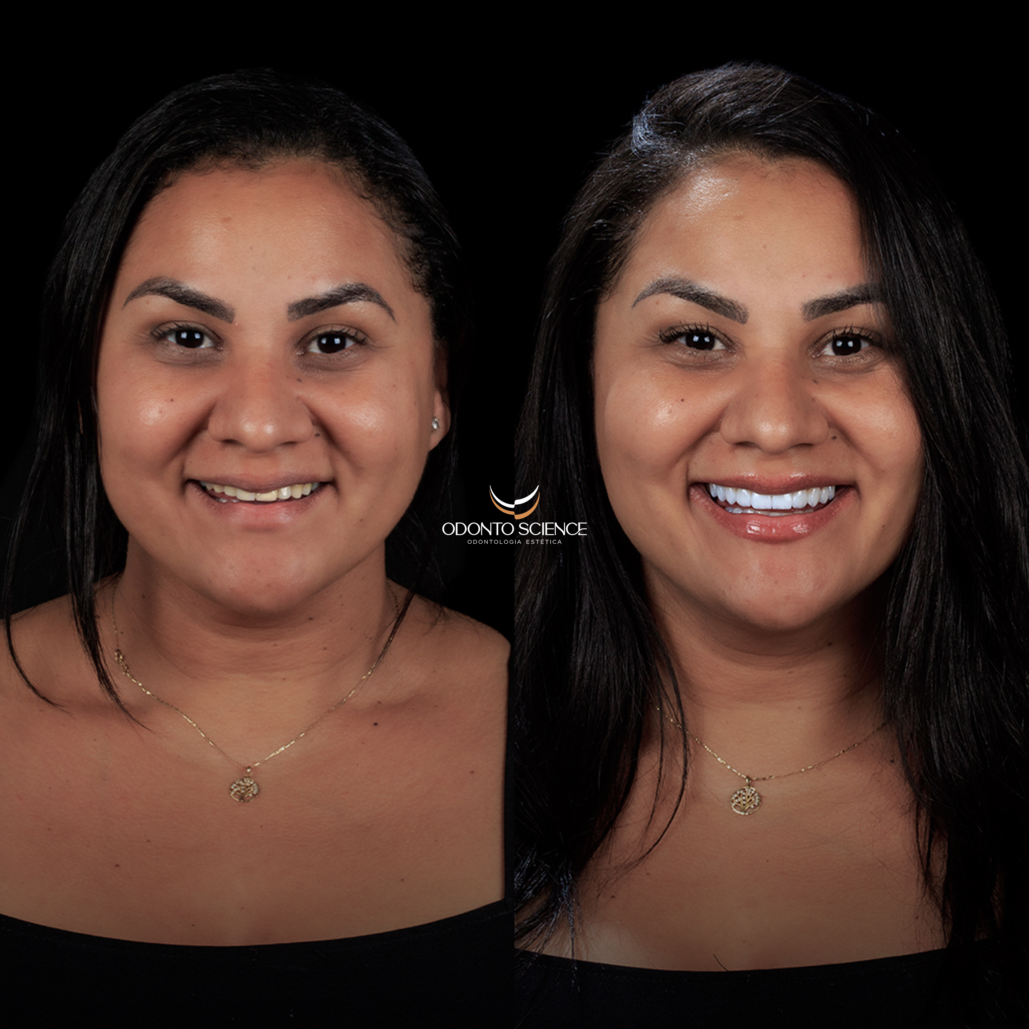 ADELIANE ANTES E DEPOIS