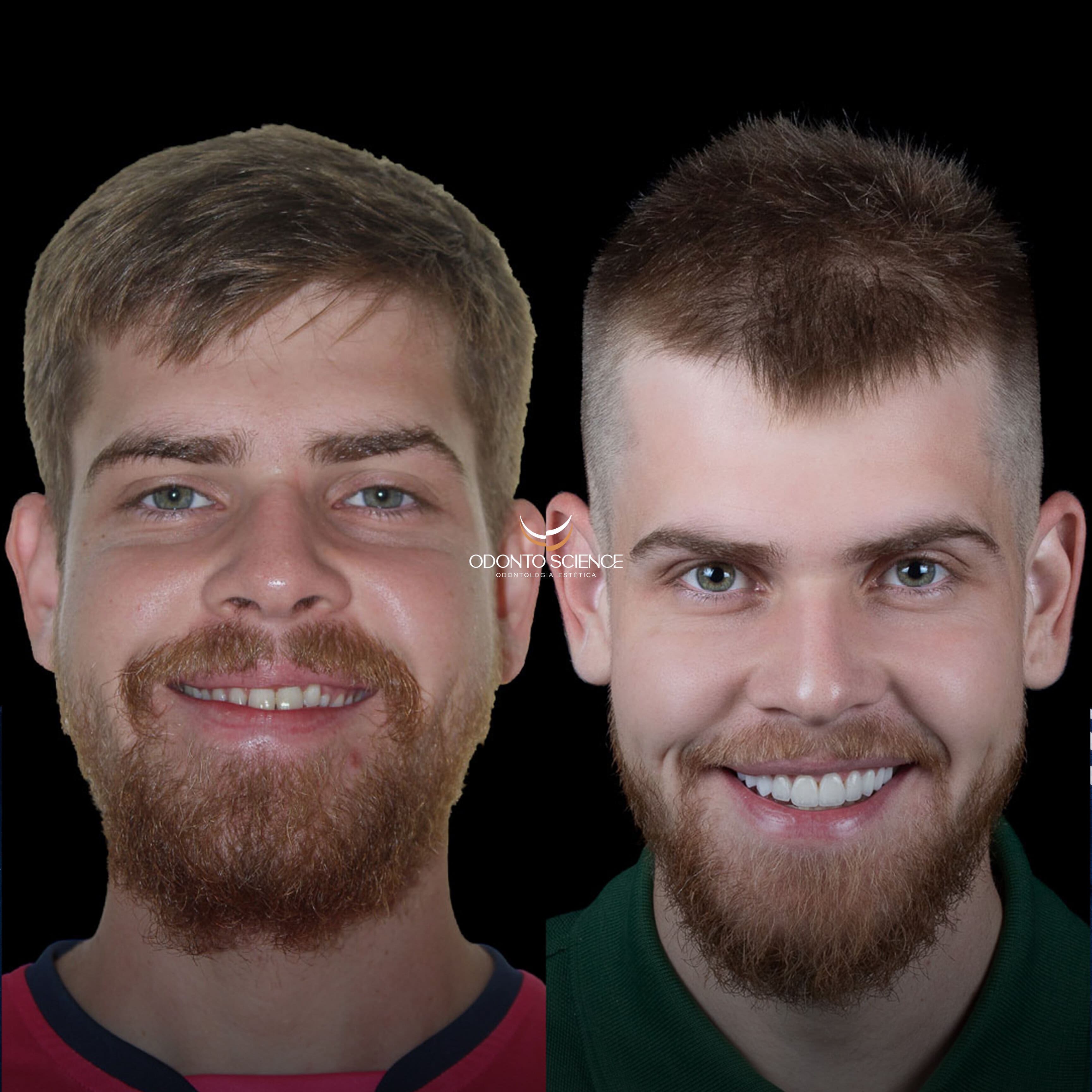 LUCAS PUBLIZT ANTES E DEPOIS