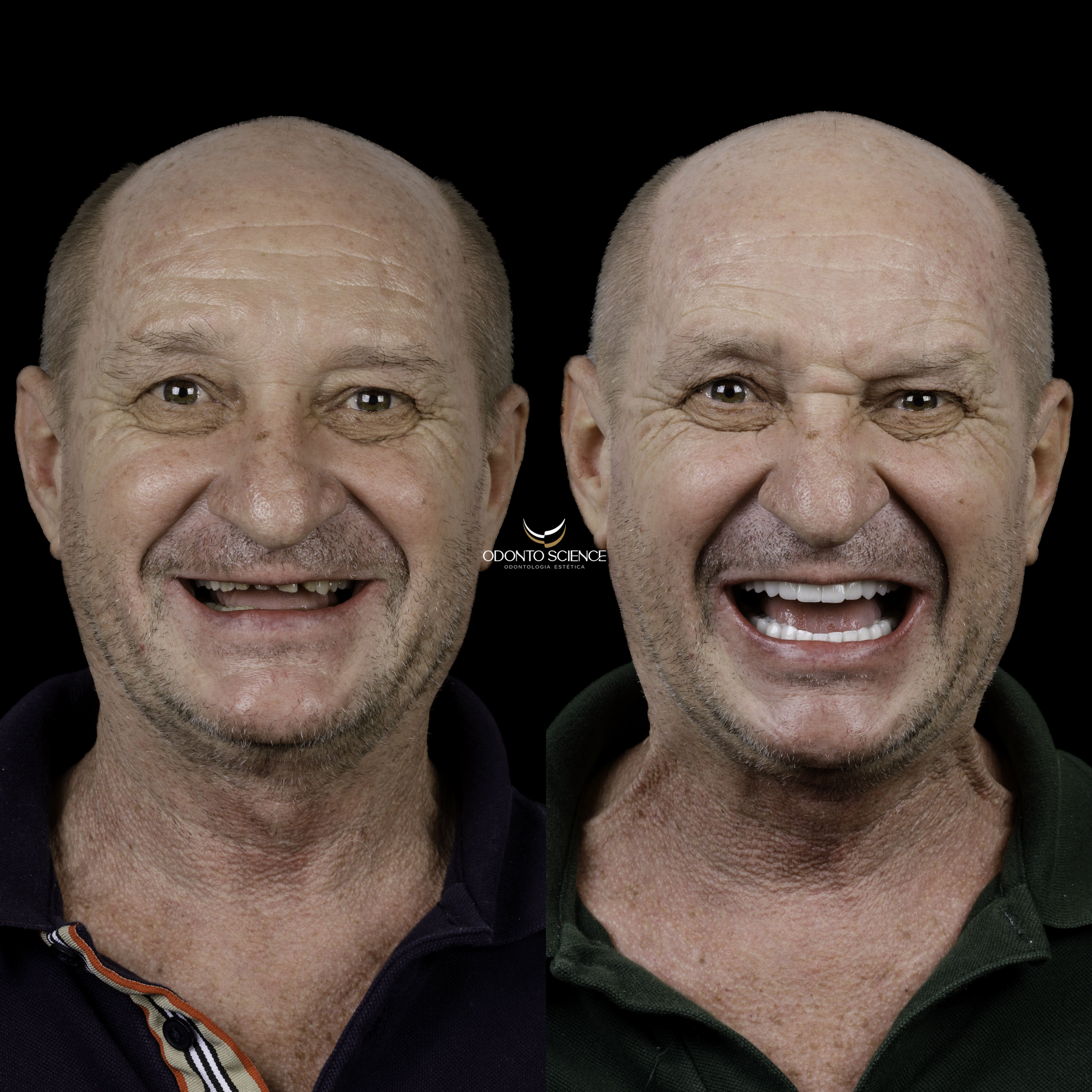 NILO ANTES E DEPOIS_